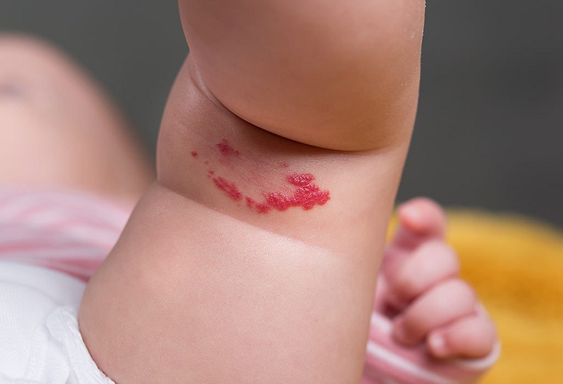 Triệu chứng khối u máu xuất hiện trên da của trẻ